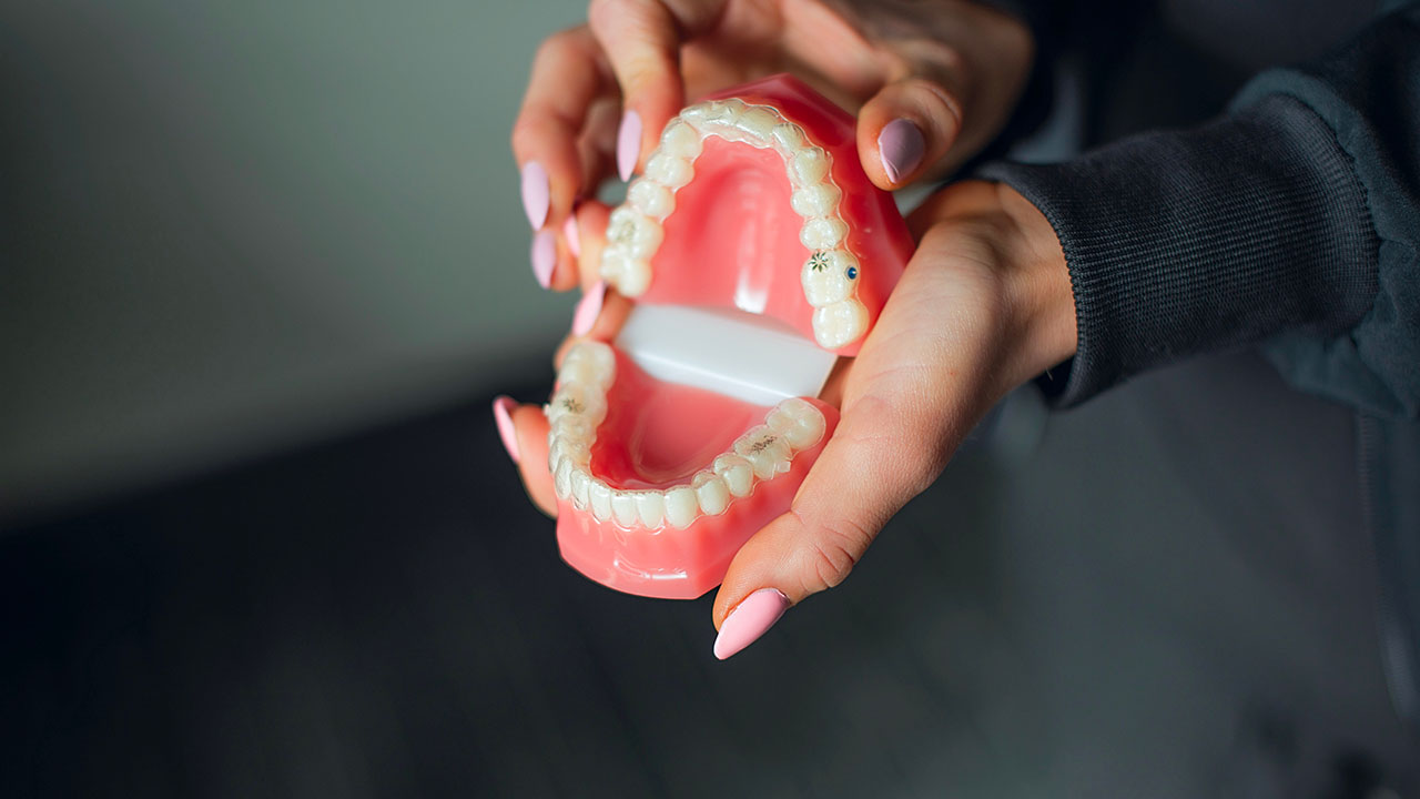 Benefits of Invisalign® Clear Aligners